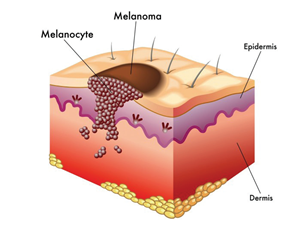 Eine mole ist eine Natürliche formation, die entfernt werden können, indem Skincell Pro
